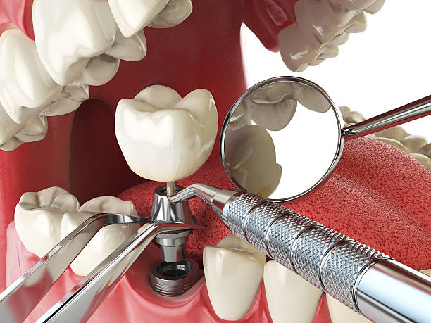 Best Emergency Treatment for Dental Infections or Abscesses in Wurtsboro, NY